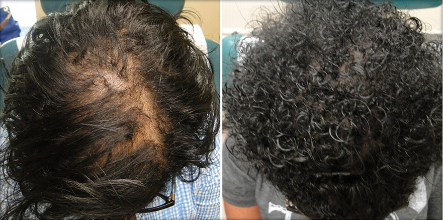Click here to see stunning before & after photos of Platelet Rich Plasma Therapy.