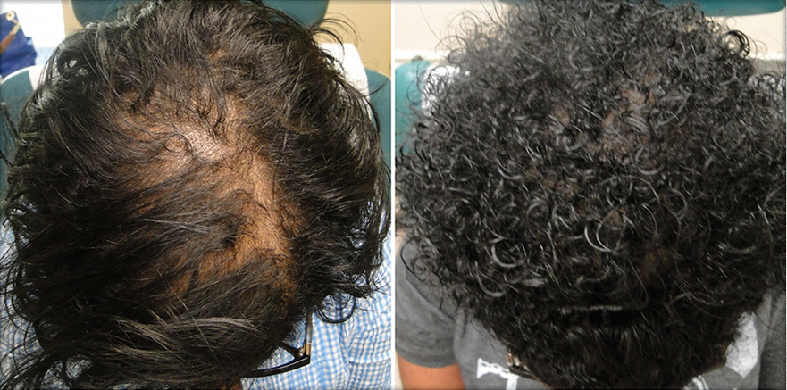 platelet enriched plasma hair loss